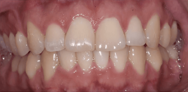 Mans mouth after invisalign and bondings, encino ca