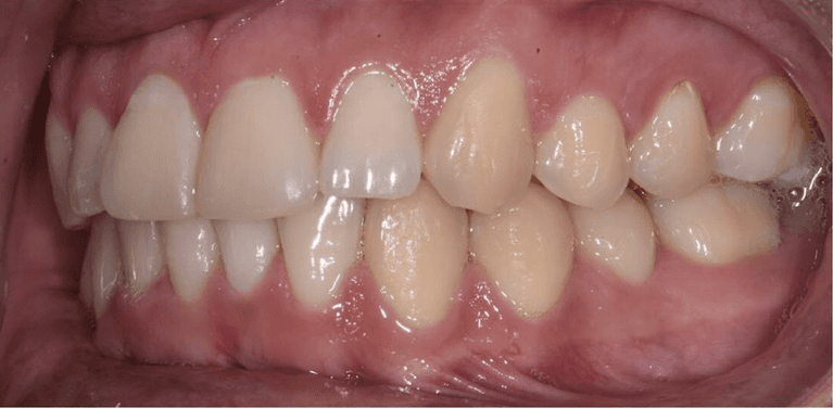 Side view of teeth after invisalign, encino ca