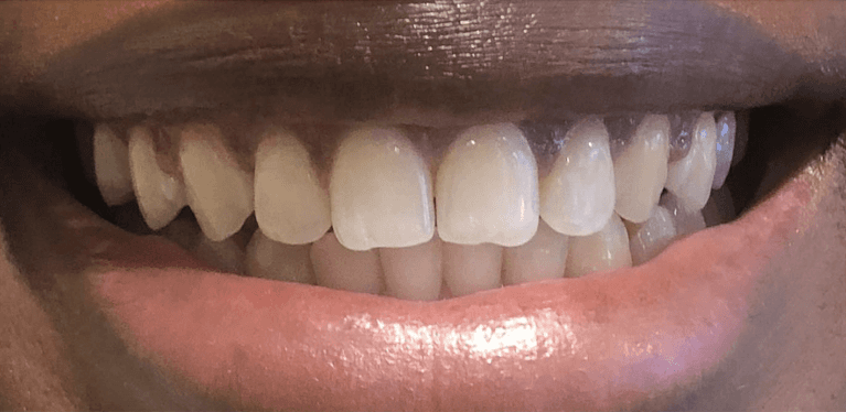 Invisalign-After-Image