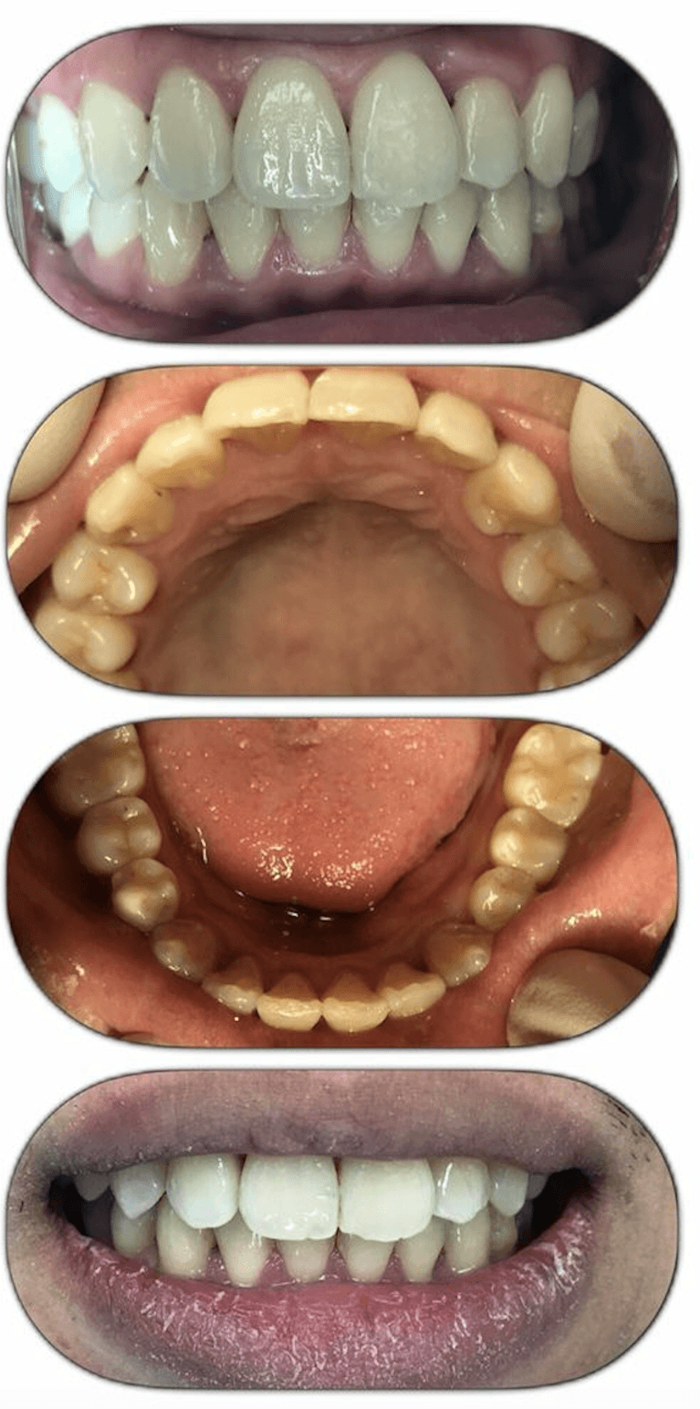 Multiple pictures of mouth after invisalign, encino ca