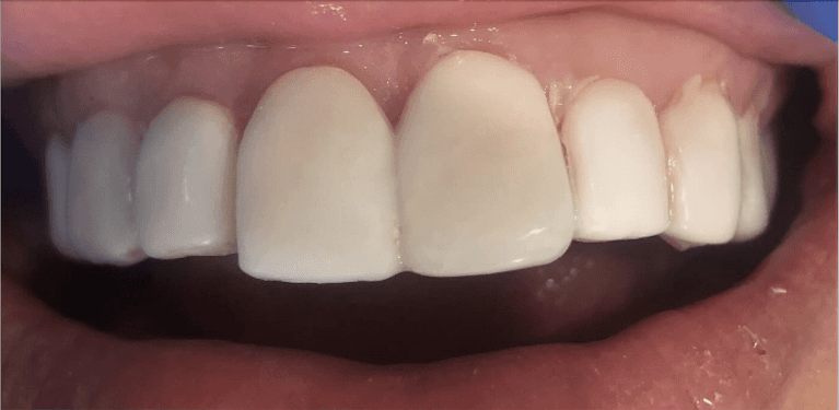 Porcelain-Veneers-After-Image