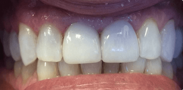 Mouth after porcelain veneers, encino ca