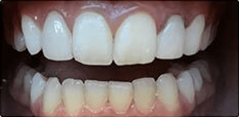 Full teeth after porcelain veneers, encino ca