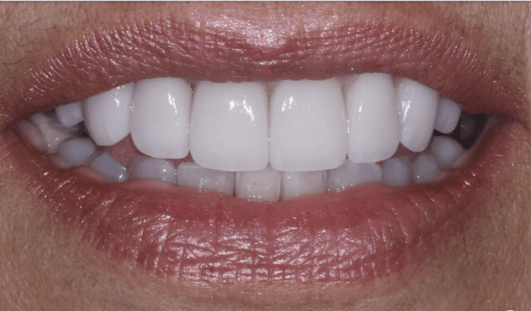 Porcelain-Veneers-After-Image