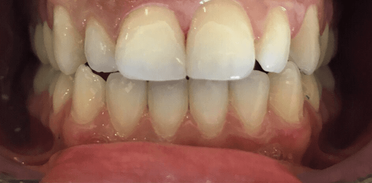 After tooth colored bondings, encino ca