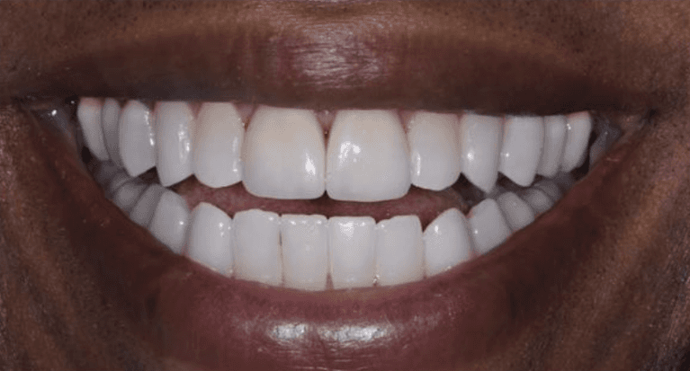 After two porcelain veneers on the front teeth, encino ca