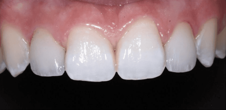 After veneers on two side teeth, encino ca