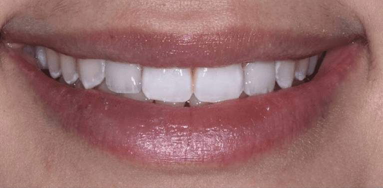 Full mouth view after veneers on two side teeth, encino ca