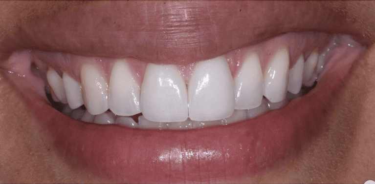 Close up of womans mouth after veneers, encino ca