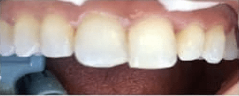 Mouth before composite bondings, encino ca