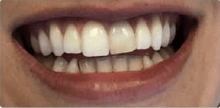 Teeth before dental crowns, encino ca