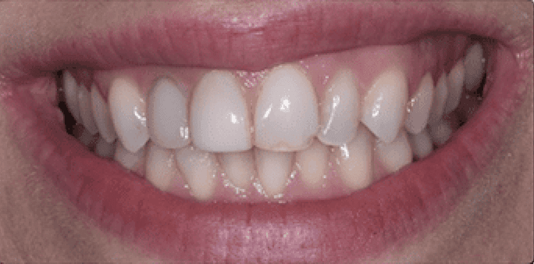 Before four front porcelain veneers, encino ca