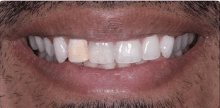 Mans mouth before four front porcelain veneers, encino ca