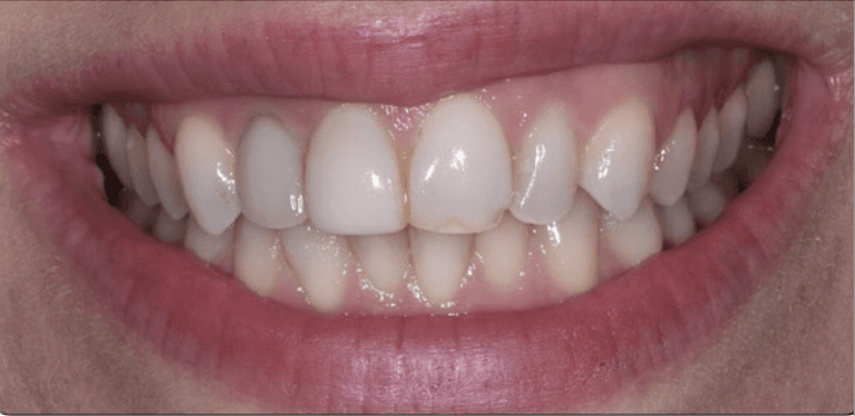 Four-Front-Veneers-Before-Image