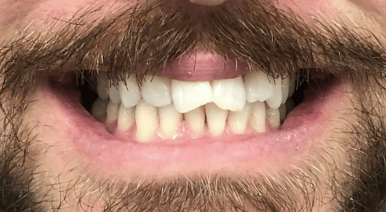 Before invisalign and bondings, encino ca