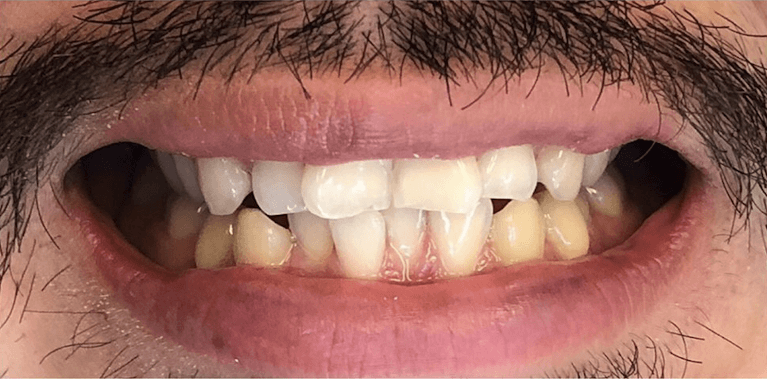 Before invisalign and bondings on two front teeth, encino ca