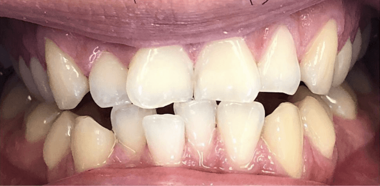 Mans mouth before invisalign and bondings, encino ca