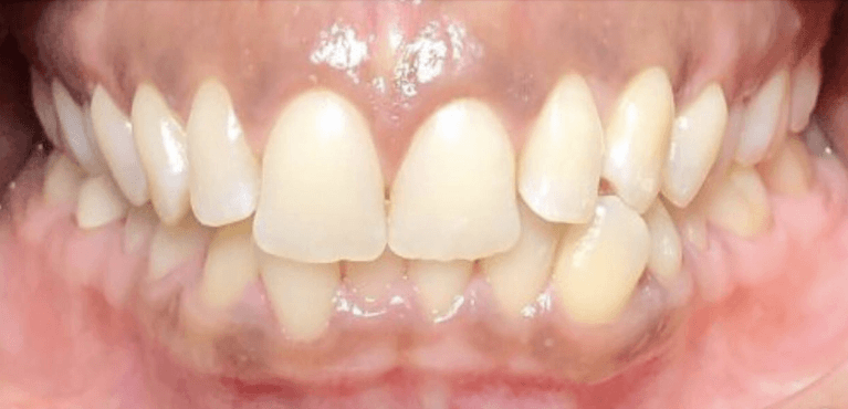 Invisalign-Before-Image