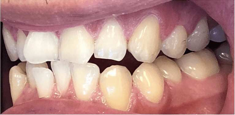 Side view of teeth before invisalign, encino ca