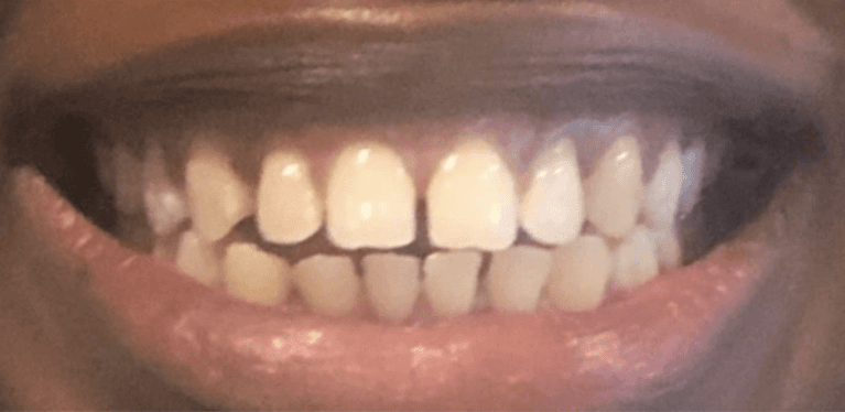 Invisalign-Before-Image