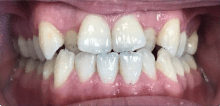 Full mouth before invisalign, encino ca