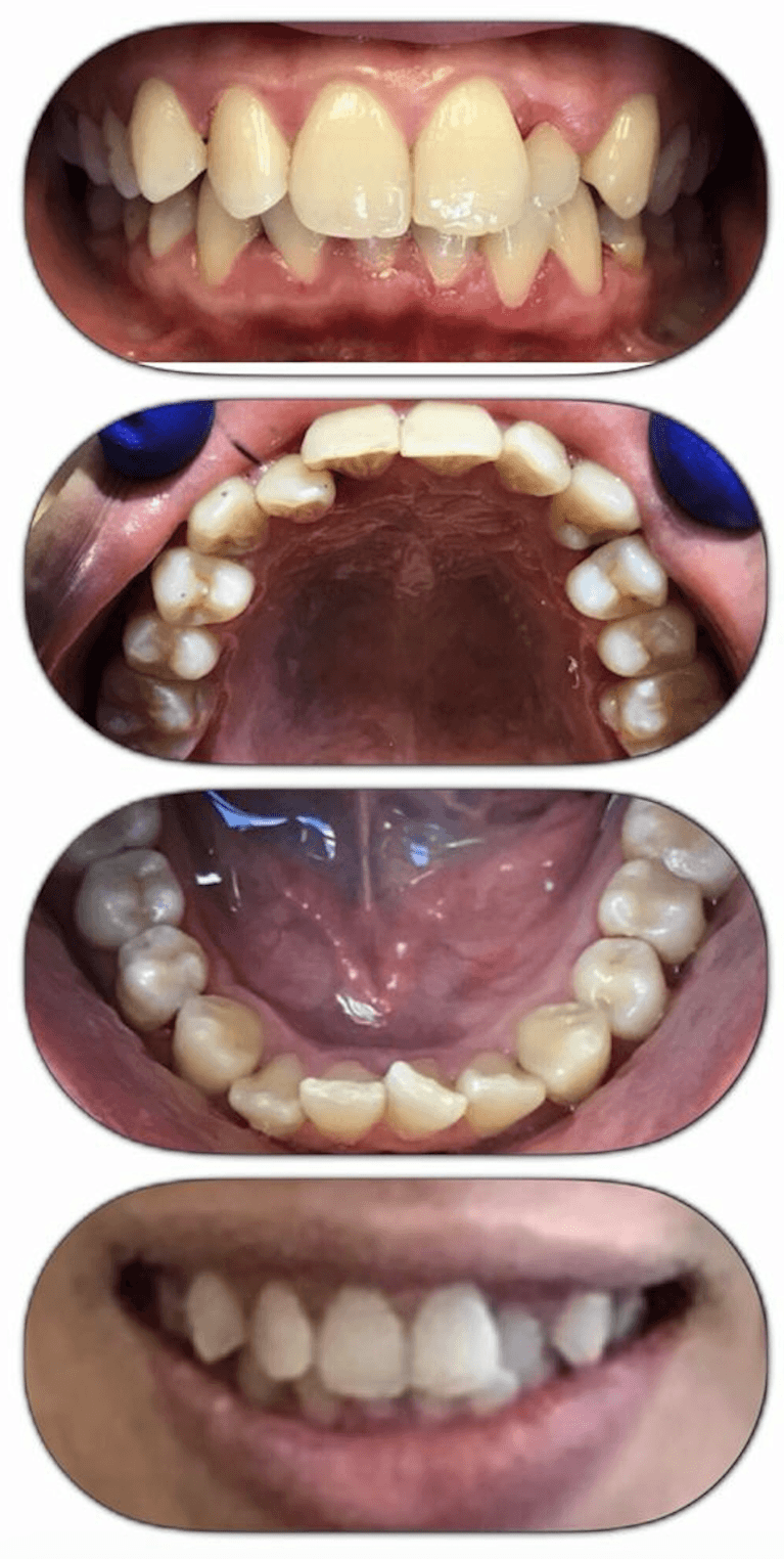 Multiple pictures of mouth before invisalign, encino ca