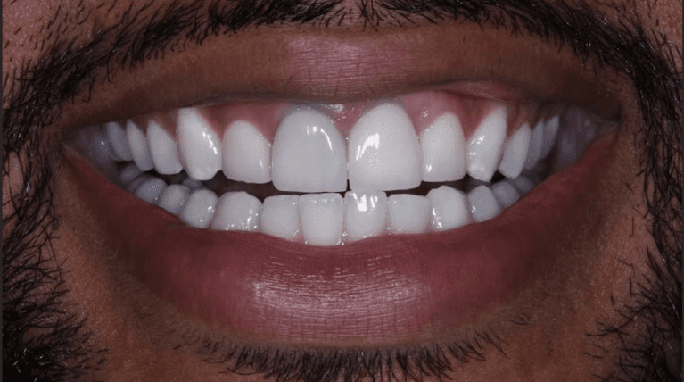 Porcelain-Veneers-and-Crowns-Before-Image