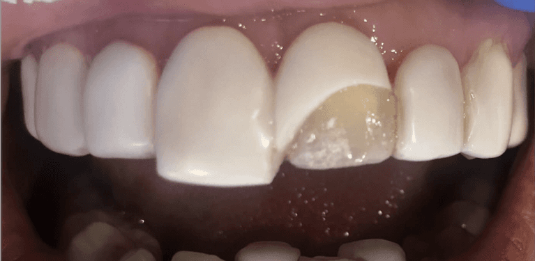 Porcelain-Veneers-Before-Image