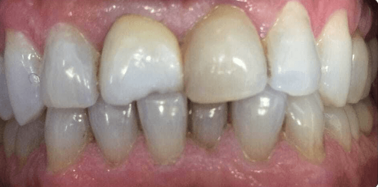 Mouth before porcelain veneers, encino ca