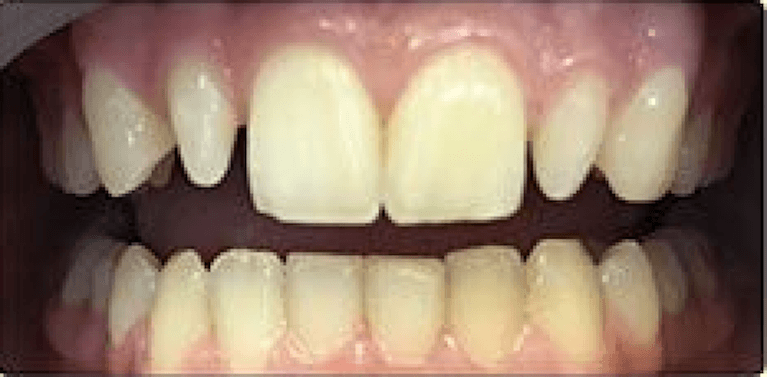 Full teeth before porcelain veneers, encino ca