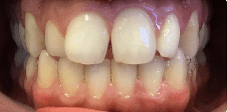 Before tooth colored bondings, encino ca