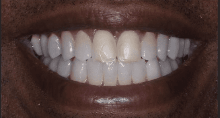 Before two porcelain veneers on the front teeth, encino ca