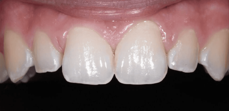 Before veneers on two side teeth, encino ca