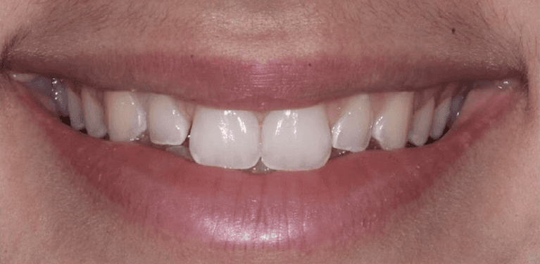 Full mouth view before veneers on two side teeth, encino ca