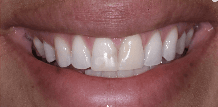 Close up of womans mouth before veneers, encino ca