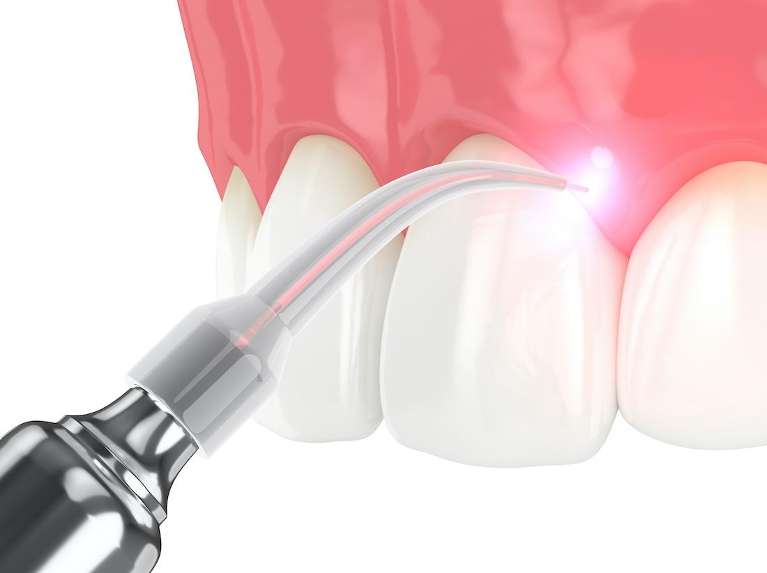 Laser dentistry being used on a tooth at signature smiles in encino ca