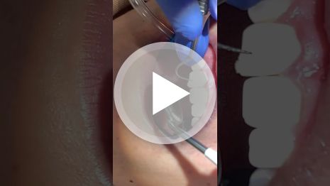Close up of a patient getting dental work done